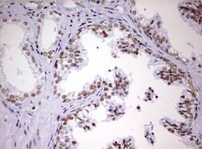 Immunohistochemistry: DDX56 Antibody (OTI2E5) - Azide and BSA Free [NBP2-71964] - Analysis of Carcinoma of Human prostate tissue. (Heat-induced epitope retrieval by 10mM citric buffer, pH6.0, 120C for 3min)