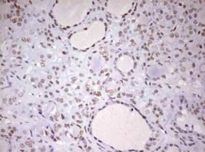 Immunohistochemistry: DDX56 Antibody (OTI2E5) - Azide and BSA Free [NBP2-71964] - Analysis of Carcinoma of Human thyroid tissue. (Heat-induced epitope retrieval by 10mM citric buffer, pH6.0, 120C for 3min)