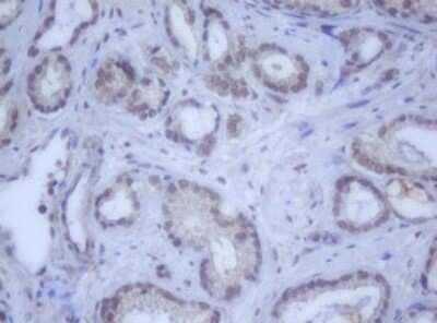 Immunohistochemistry: DDX59 Antibody (2G1) [NBP2-46447] - Analysis of Carcinoma of Human prostate tissue. (Heat-induced epitope retrieval by 10mM citric buffer, pH6.0, 120C for 3min)