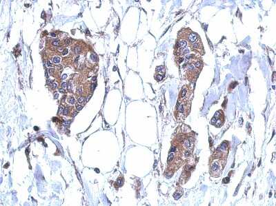 Immunohistochemistry-Paraffin: DDX59 Antibody [NBP2-16142] - Immunohistochemical analysis of paraffin-embedded BREAST CA, using antibody at 1:500 dilution.
