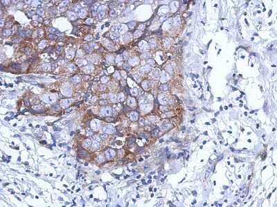 Immunohistochemistry-Paraffin: DDX59 Antibody [NBP2-16143] - Immunohistochemical analysis of paraffin-embedded Breast ca, using antibody at 1:500 dilution.