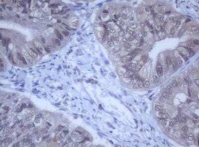 Immunohistochemistry: DDX59 Antibody (OTI2G1) - Azide and BSA Free [NBP2-72229] - Analysis of Adenocarcinoma of Human endometrium tissue. (Heat-induced epitope retrieval by 10mM citric buffer, pH6.0, 120C for 3min)