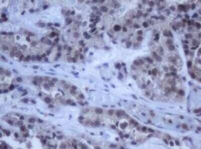 Immunohistochemistry: DDX59 Antibody (OTI2G1) - Azide and BSA Free [NBP2-72229] - Analysis of Adenocarcinoma of Human ovary tissue. (Heat-induced epitope retrieval by 10mM citric buffer, pH6.0, 120C for 3min)