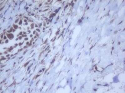 Immunohistochemistry: DDX59 Antibody (OTI2G1) - Azide and BSA Free [NBP2-72229] - Analysis of Carcinoma of Human bladder tissue. (Heat-induced epitope retrieval by 10mM citric buffer, pH6.0, 120C for 3min)