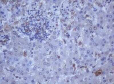 Immunohistochemistry: DDX59 Antibody (OTI2G1) - Azide and BSA Free [NBP2-72229] - Analysis of Carcinoma of Human liver tissue.(Heat-induced epitope retrieval by 10mM citric buffer, pH6.0, 120C for 3min)