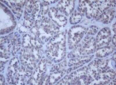 Immunohistochemistry: DDX59 Antibody (OTI2G1) - Azide and BSA Free [NBP2-72229] - Analysis of Carcinoma of Human thyroid tissue. (Heat-induced epitope retrieval by 10mM citric buffer, pH6.0, 120C for 3min)