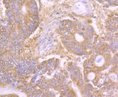 Immunohistochemistry-Paraffin: DEC-205/CD205 Antibody (JB87-35) [NBP2-75467] - Analysis of paraffin-embedded human colon cancer tissue using anti-LY75 antibody. Counter stained with hematoxylin.