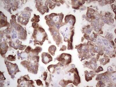 Immunohistochemistry: DEC2/SHARP1 Antibody (OTI5B1) - Azide and BSA Free [NBP2-72203] - Analysis of Adenocarcinoma of Human ovary tissue.