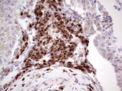 Immunohistochemistry: DEC2/SHARP1 Antibody (OTI5B1) - Azide and BSA Free [NBP2-72203] - Analysis of Carcinoma of Human lung tissue.