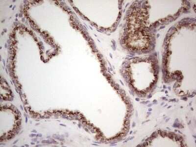 Immunohistochemistry: DEC2/SHARP1 Antibody (OTI5B1) - Azide and BSA Free [NBP2-72203] - Analysis of Carcinoma of Human prostate tissue.