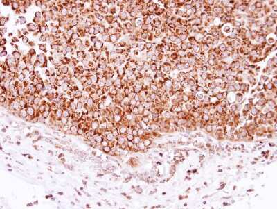 Immunohistochemistry-Paraffin: DECR1 Antibody [NBP2-16144] - Immunohistochemical analysis of paraffin-embedded Breast ca, using antibody at 1:250 dilution.