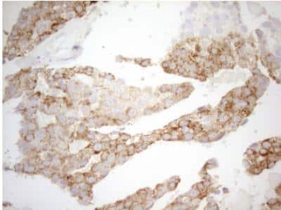 Immunohistochemistry-Paraffin: DECR1 Antibody (OTI4G4) [NBP2-46449] -  Staining of paraffin-embedded Adenocarcinoma of Human breast tissue tissue using anti-DECR1 mouse monoclonal antibody. (Heat-induced epitope retrieval by 1mM EDTA in 10mM Tris buffer (pH8.5) at 120 degrees C for 3 min,1:150)