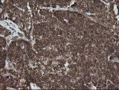 Immunohistochemistry: DEF6 Antibody (OTI3F9) - Azide and BSA Free [NBP2-71868] - Analysis of Human lymphoma tissue.