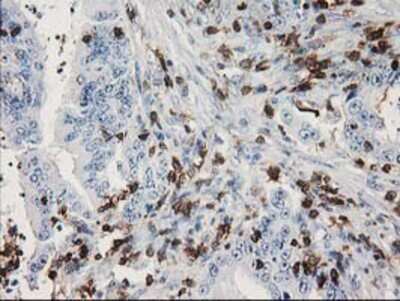 Immunohistochemistry-Paraffin: DEF8 Antibody (4B6) [NBP2-00574] - Staining of paraffin-embedded Adenocarcinoma of Human colon tissue using anti-DEF8 mouse monoclonal antibody.