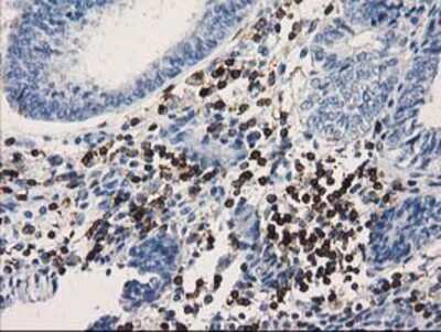 Immunohistochemistry-Paraffin: DEF8 Antibody (4B6) [NBP2-00574] - Staining of paraffin-embedded Adenocarcinoma of Human endometrium tissue using anti-DEF8 mouse monoclonal antibody.