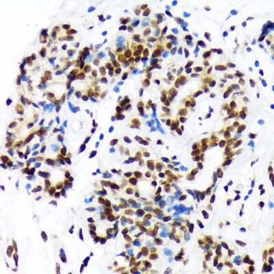 Immunohistochemistry-Paraffin: DEK Antibody (2C2V8) [NBP3-15257] - Immunohistochemistry of paraffin-embedded human breast cancer using DEK Rabbit mAb (NBP3-15257) at dilution of 1:100 (40x lens).Perform microwave antigen retrieval with 10 mM Tris/EDTA buffer pH 9.0 before commencing with IHC staining protocol.