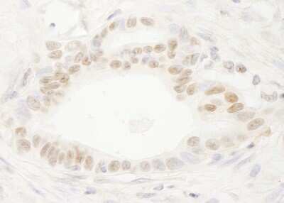 <b>Independent Antibodies Validation. </b>Immunohistochemistry: DEK Antibody [NB100-61058] - Sample: FFPE section of human stomach carcinoma. Antibody: Affinity purified rabbit anti-DEK used at a dilution of 1:200 ( 1ug/ml). Detection: DAB