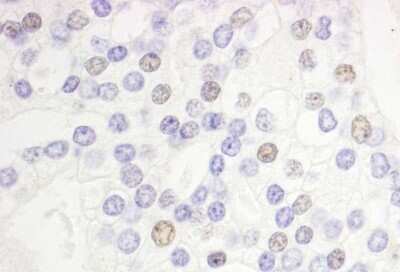 Immunohistochemistry-Paraffin: DEK Antibody [NB100-61057] - Human prostate carcinoma. Antibody used at a dilution of 1:1000 (1ug/ml).