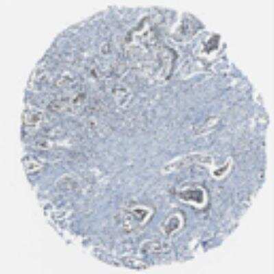 Immunohistochemistry: DEPDC1A Antibody [26630002] - Most of the normal tissues displayed weak nuclear positivity. Moderate immunoreactivity was seen in trophoblastic cells, glandular cells of gastro-intestinal tract and thyroid gland, glomerular and tubular cells of kidney. Lymphoid tissues and myocytes were negative. A majority of cancers showed moderate nuclear positivity. Lymphomas were weakly stained. Hepatocellular carcinomas were negative.  Image and statement courtesy of the Human Protein Atlas (HPA).