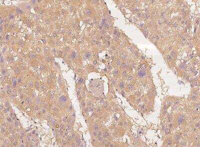 Immunohistochemistry-Paraffin: DGK-iota Antibody [NBP3-06558] - Staining of human DGKI in human hepatoma with rabbit polyclonal antibody at 1:100 dilution.