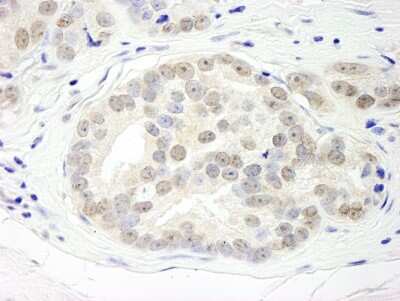 Immunohistochemistry: DHX15 Antibody [NB100-585] - Sample: FFPE section of human prostate carcinoma. Antibody: Affinity purified rabbit anti-DHX15 used at a dilution of 1:1,000 ( 1ug/ml). Detection: DAB