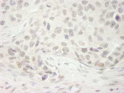 Immunohistochemistry: DHX33 Antibody [NB100-2580] - FFPE section of human breast carcinoma. Antibody used at a dilution of 1:250.  Detection by DAB staining. Epitope Retrieval Buffer-High pH was substituted for Epitope Retrieval Buffer-Reduced pH.