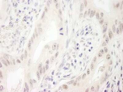 Immunohistochemistry-Paraffin: DHX33 Antibody [NB100-2580] - Human lung carcinoma. Antibody used at a dilution of 1:1000 (1ug/ml).