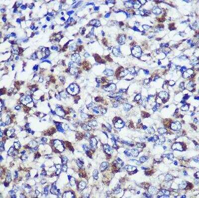 Immunohistochemistry-Paraffin: DIS3L Antibody [NBP2-92142] - Human liver cancer using DIS3L Rabbit pAb at dilution of 1:100 (40x lens).
