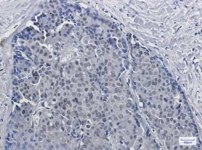 Immunohistochemistry-Paraffin: DKC1 Antibody (S02-2D8) [NBP3-14925] - Immunohistochemistry of DKC1 in paraffin-embedded Human breast cancer tissue using DKC1 Rabbit mAb at dilution 1/50