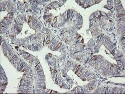 Immunohistochemistry: DKFZp566F084 Antibody (OTI4B9) - Azide and BSA Free [NBP2-71779] - Analysis of Adenocarcinoma of Human endometrium tissue. (Heat-induced epitope retrieval by 10mM citric buffer, pH6.0, 120C for 3min)