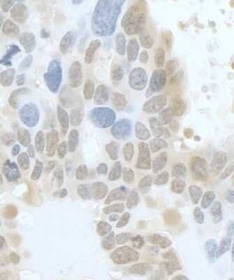 Immunohistochemistry-Paraffin: DLG7/HURP Antibody [NB110-40573] - Sample: FFPE section of human ovarian carcinoma. Antibody: Affinity purified rabbit anti- HURP/DLG7 used at a dilution of 1:200 (1ug/ml). Detection: DAB