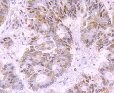 Immunohistochemistry-Paraffin: DNA Ligase IV Antibody (JM64-32) [NBP2-75474] - Analysis of paraffin-embedded human colon cancer tissue using anti-DNA Ligase IV antibody. Counter stained with hematoxylin.