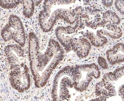 Immunohistochemistry-Paraffin: DNA-PKcs Antibody (SC57-08) [NBP2-67554] - Human colon carcinoma tissue with Rabbit anti-DNA PKcs antibody at 1/200 dilution. The section was pre-treated using heat mediated antigen retrieval with sodium citrate buffer (pH 6.0) for 2 minutes. The tissues were blocked in 1% BSA for 20 minutes at room temperature, washed with ddH2O and PBS, and then probed with the primary antibody at 1/200 dilution for 1 hour at room temperature. The detection was performed using an HRP conjugated compact polymer system. DAB was used as the chromogen. Tissues were counterstained with hematoxylin and mounted with DPX.