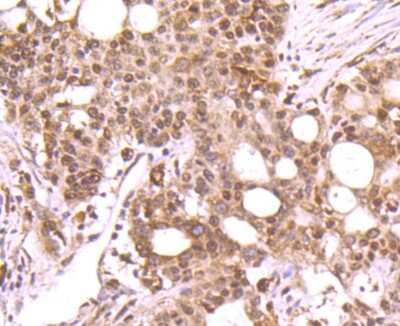 Immunohistochemistry-Paraffin: DNA Polymerase beta Antibody (JM93-12) [NBP2-67036] - Analysis of paraffin-embedded human stomach cancer tissue using anti-DNA Polymerase beta antibody. Counter stained with hematoxylin.