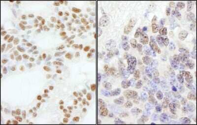 Immunohistochemistry-Paraffin: DNA Polymerase epsilon subunit 3 Antibody [NB100-60438] - Section of human ovarian carcinoma (left) and mouse teratoma (right). Antibody: Affinity purified rabbit anti- PolE3/p17 used at a dilution of 1:5,000 (0.2ug/ml). Detection: DAB