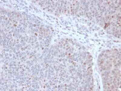 Immunohistochemistry-Paraffin: DNA Polymerase epsilon subunit 3 Antibody (PCRP-POLE3-2F10) [NBP3-07616] - Formalin-fixed, paraffin-embedded human lymphoma stained with DNA Polymerase epsilon subunit 3 Mouse Monoclonal Antibody (PCRP-DNA Polymerase epsilon subunit 3-2F10).