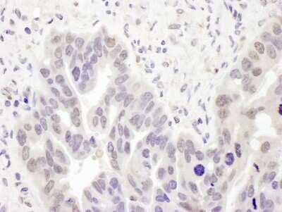 <b>Independent Antibodies Validation. </b>Immunohistochemistry: DNA polymerase delta p50 Antibody [NBP2-32093] - Sample: FFPE section of human ovarian carcinoma. Antibody: Affinity purified rabbit anti- PolD2 used at a dilution of 1:1,000 (1ug/ml). Detection: DAB. Counterstain: IHC Hematoxylin (blue).