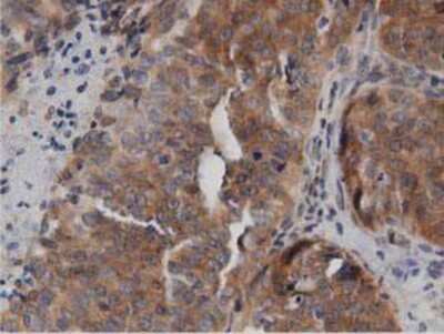 Immunohistochemistry-Paraffin: DNAJA2 Antibody (3A10) [NBP2-02996] - Staining of paraffin-embedded Adenocarcinoma of Human ovary tissue using anti-DNAJA2 mouse monoclonal antibody.