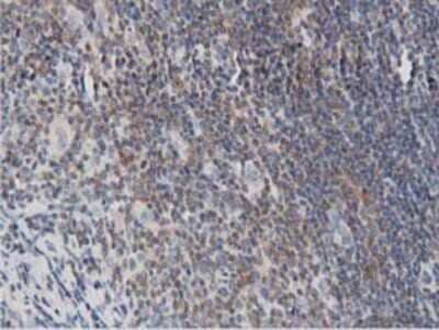 Immunohistochemistry-Paraffin: DNAJA2 Antibody (3A10) [NBP2-02996] - Staining of paraffin-embedded Human lymphoma tissue using anti-DNAJA2 mouse monoclonal antibody.