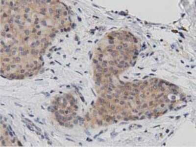 Immunohistochemistry: DNAJA2 Antibody (OTI3A10) - Azide and BSA Free [NBP2-71565] - Staining of paraffin-embedded Adenocarcinoma of Human breast tissue using anti-DNAJA2 mouse monoclonal antibody.