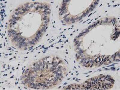 Immunohistochemistry: DNAJA2 Antibody (OTI3A10) - Azide and BSA Free [NBP2-71565] - Staining of paraffin-embedded Adenocarcinoma of Human endometrium tissue using anti-DNAJA2 mouse monoclonal antibody.