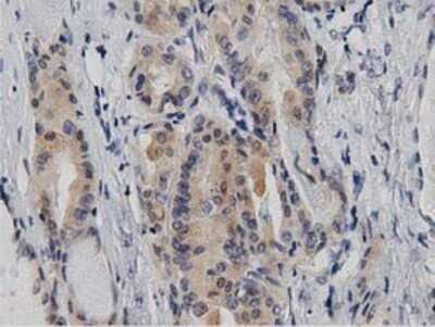 Immunohistochemistry: DNAJA2 Antibody (OTI3A10) - Azide and BSA Free [NBP2-71565] - Staining of paraffin-embedded Carcinoma of Human thyroid tissue using anti-DNAJA2 mouse monoclonal antibody.