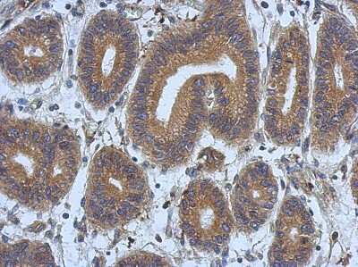 Immunohistochemistry-Paraffin: DNAJB12 Antibody [NBP2-16191] - Immunohistochemical analysis of paraffin-embedded Colon ca, using antibody at 1:500 dilution.