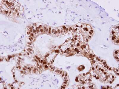 Immunohistochemistry-Paraffin: DNAJB2 Antibody [NBP1-32249] - Paraffin-embedded Ovarian Carcinoma; antibody dilution 1:500.