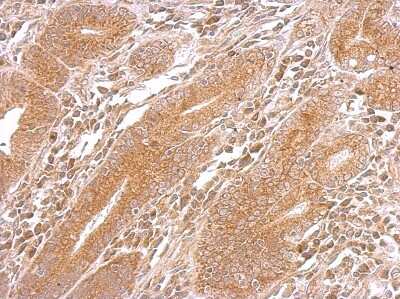 Immunohistochemistry-Paraffin: DNAJB5 Antibody [NBP2-16192] - DNAJB5 antibody detects DNAJB5 protein at cytosol on colon carcinoma by immunohistochemical analysis. Sample: Paraffin-embedded colon carcinoma. DNAJB5 antibody dilution: 1:200.
