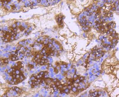 Immunohistochemistry-Paraffin: DNAJC15 Antibody (SY26-04) [NBP2-67439] - Analysis of paraffin-embedded human liver cancer tissue using anti-DNAJC15 antibody. Counter stained with hematoxylin.