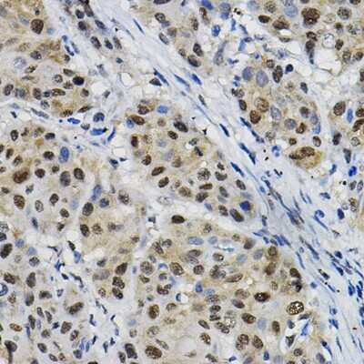 Immunohistochemistry-Paraffin: DNAJC17 Antibody [NBP3-15969] - Immunohistochemistry of paraffin-embedded human esophageal cancer using DNAJC17 Rabbit pAb (NBP3-15969) at dilution of 1:25 (40x lens).Perform high pressure antigen retrieval with 10 mM citrate buffer pH 6.0 before commencing with IHC staining protocol.