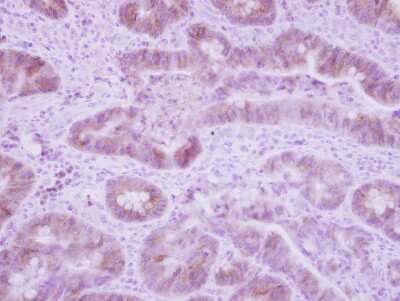 Immunohistochemistry-Paraffin: DNAJC3 Antibody [NBP2-16195] - Immunohistochemical analysis of paraffin-embedded Colon ca, using antibody at 1:250 dilution.