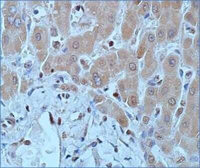 Immunohistochemistry: DNMT1 Antibody (60B1220.1) - Azide and BSA Free [NBP2-80697] - Tissue section of human hepatocellular carcinoma at 1:50 dilution. Image from the standard format of this antibody.