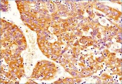 Immunohistochemistry: DNMT3A Antibody (64B1446) - Azide and BSA Free [NBP2-80699] - Detection of DNMT3A on human hepatocellular carcinoma tissue section (NBP2-30221) using 1:100 dilution of DNMT3A antibody (clone 64B1446). The antibody generated a specific cytoplasmic staining in all the cancer cells while some of the cells depicted nucl